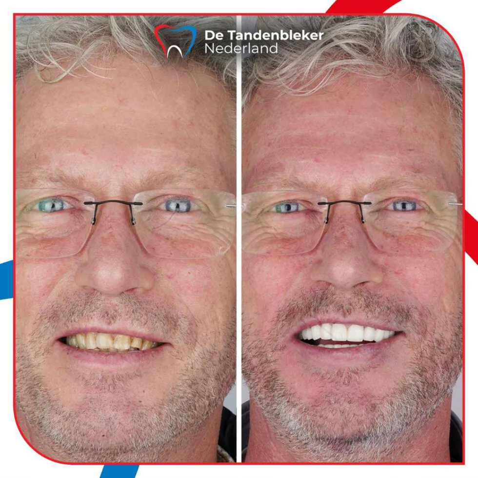 Voor en na facings — glimlach van dezelfde man voor en na de behandeling