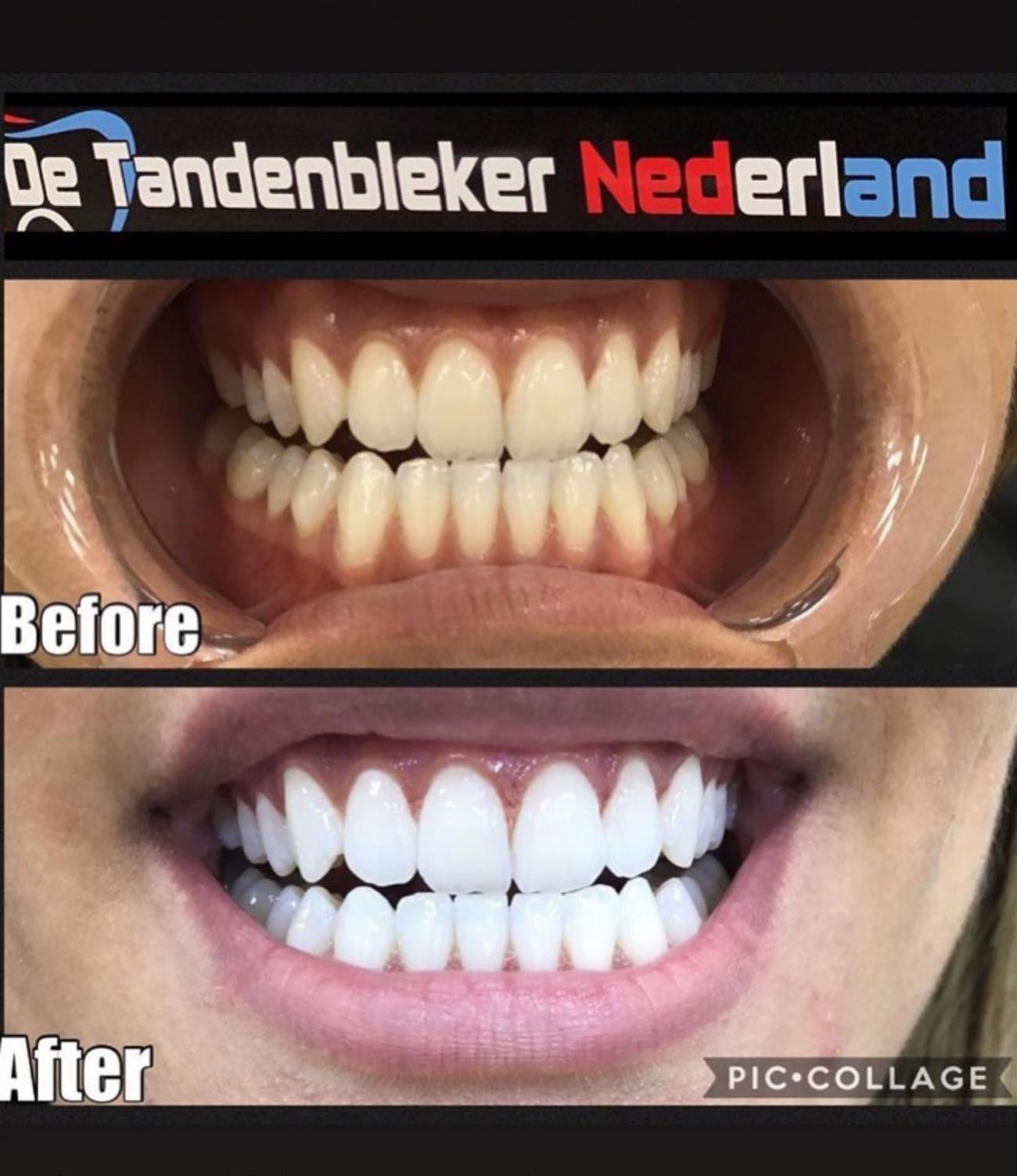 Voor en na resultaat 4 van een bleekbehandeling bij De Tandenbleker Nederland