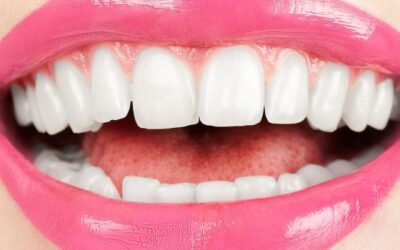 Hoe voorkom je gelere tanden