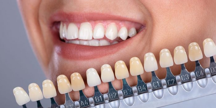 Waarom bleken mensen hun tanden