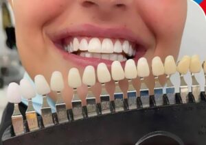 tanden-bleken-ervaringen-leiden
