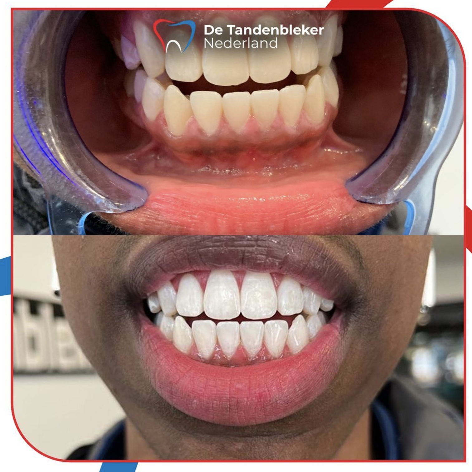 Tanden Tanden? Tandenbleker Nederland